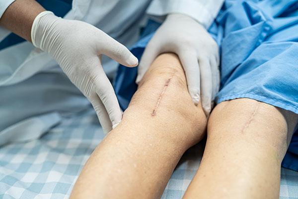 prothese de genou cicatrice suite a operation gonarthrose tri compartimentale